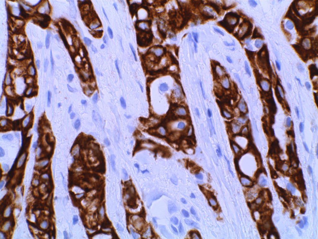 Adenomatoid Tumor CK7