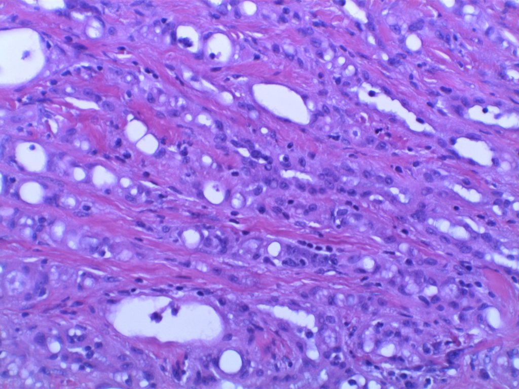 Adenomatoid Tumor_H&E