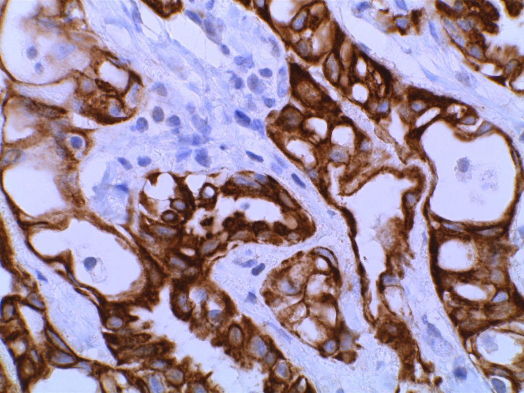 Adenomatoid Tumor MCK